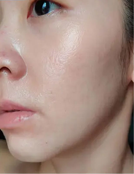 Trước sau cắt cánh mũi 4