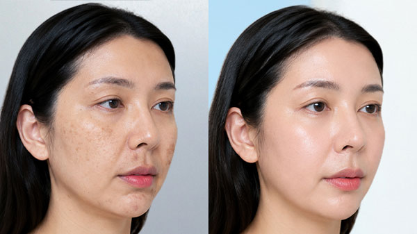 Trước và sau điều trị nám mảng sau sinh của khách hàng Duyên tại Kangnam