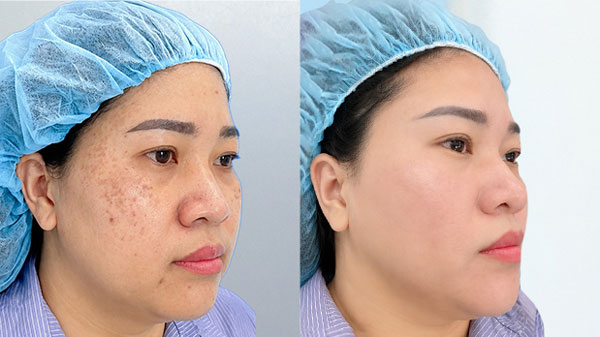 Trước và sau điều trị nám hỗn hợp của khách hàng Minh Anh tại Kangnam