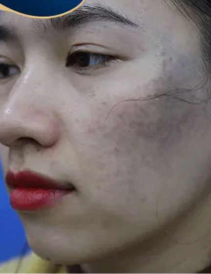 Trước sau cắt cánh mũi 1