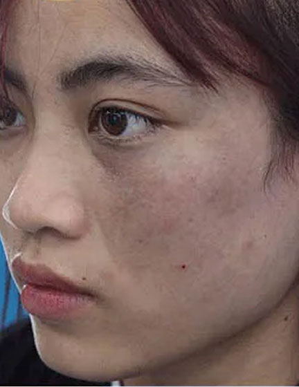 Trước sau cắt cánh mũi 3