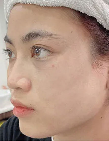 Trước sau cắt cánh mũi 4