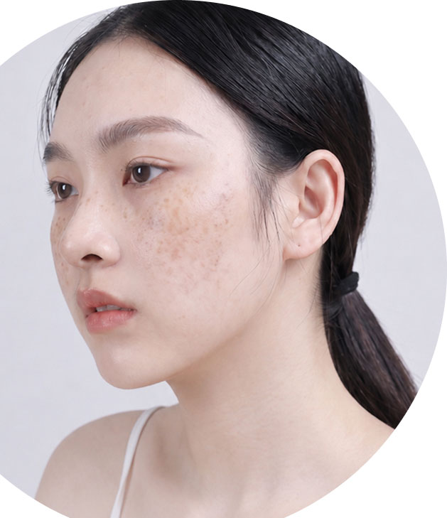 Trị bớt sắc tố
