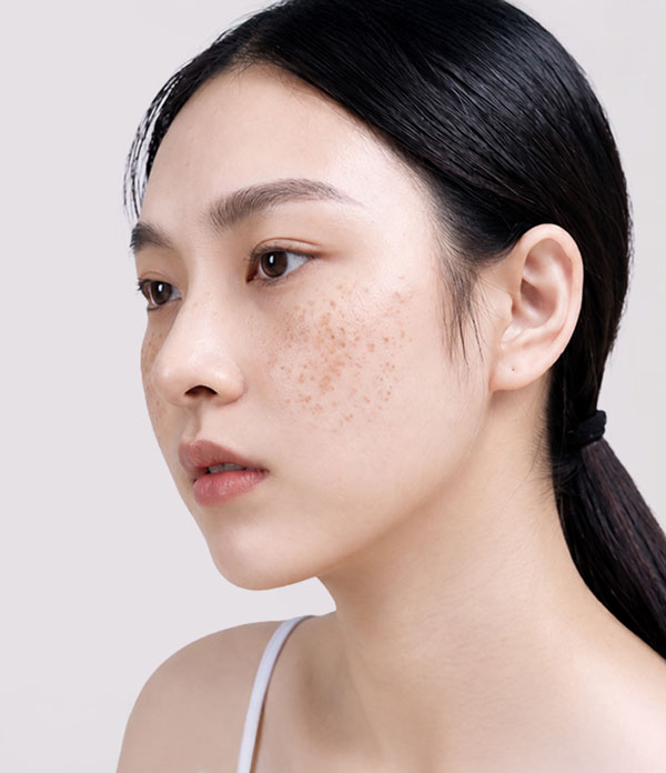 Điều trị bớt sắc tố bằng laser tại Bệnh viện Thẩm mỹ Kangnam