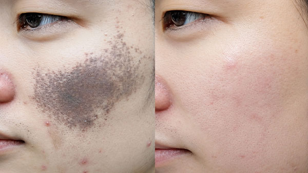 Trước và sau điều trị bớt Ota vùng má của khách hàng Nguyễn Văn Mạnh tại Kangnam
