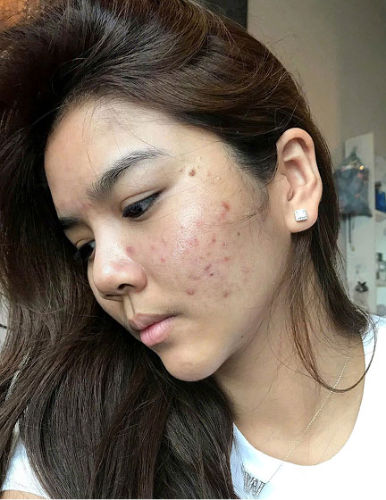 Trước sau cắt cánh mũi 1
