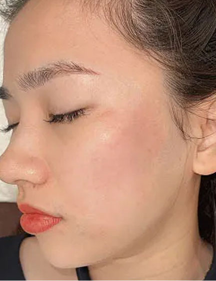 Trước sau cắt cánh mũi 2
