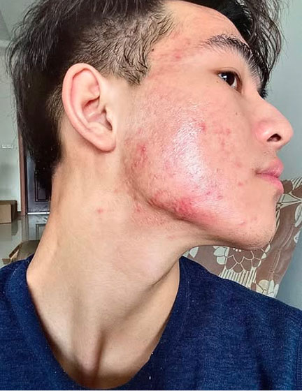 Trước sau cắt cánh mũi 3