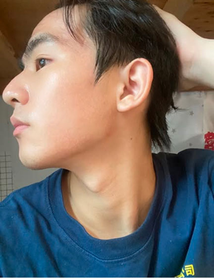 Trước sau cắt cánh mũi 4