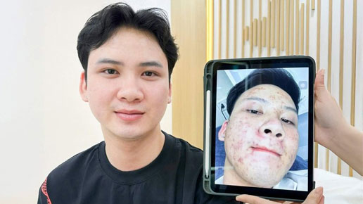 Trước và sau điều trị mụn đầu đen, mụn cám của khách hàng Hoàng Nam tại Kangnam