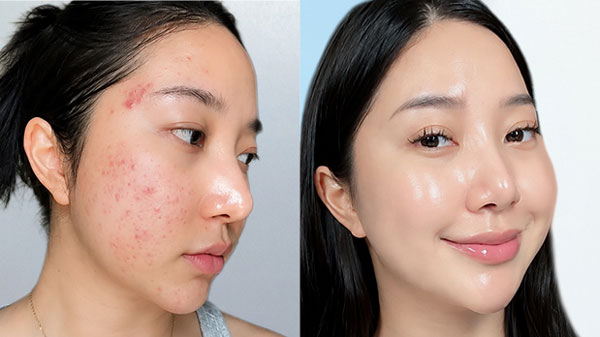 Trước và sau điều trị mụn viêm và thâm sau mụn của khách hàng Minh Anh tại Kangnam