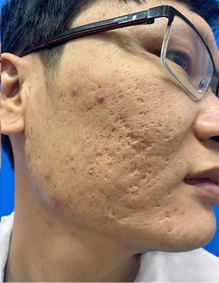 Trước sau cắt cánh mũi 1