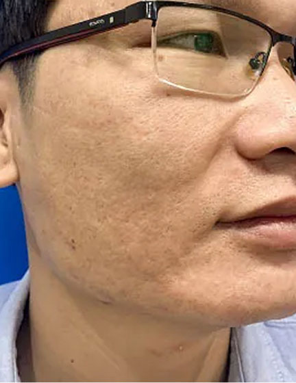 Trước sau cắt cánh mũi 2