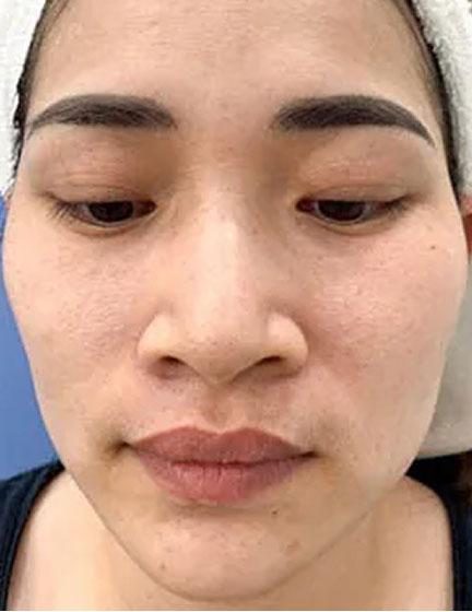 Trước sau cắt cánh mũi 4