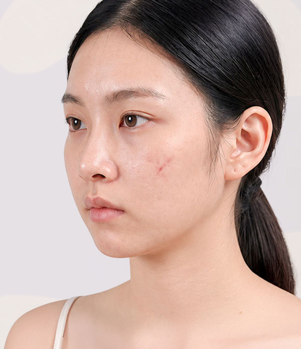 Trị sẹo rỗ, sẹo lõm bằng công nghệ da liễu tại Bệnh viện Thẩm mỹ Kangnam