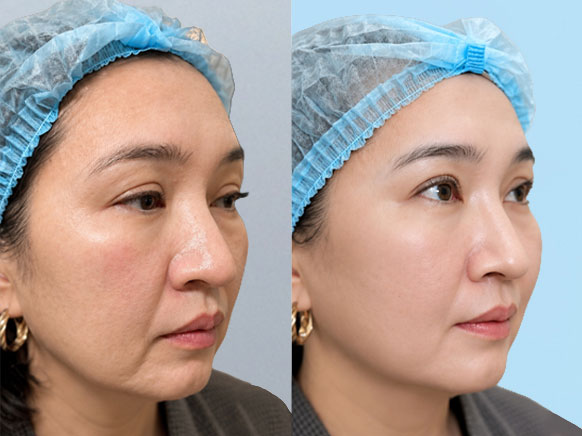 Trị sẹo rỗ sau mụn bằng Bio Scar kết hợp PRP tại Kangnam