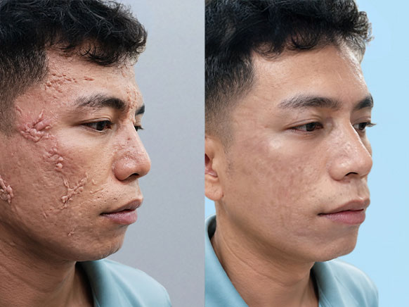 Điều trị sẹo lồi vùng mặt làm phẳng bề mặt sẹo tại Kangnam