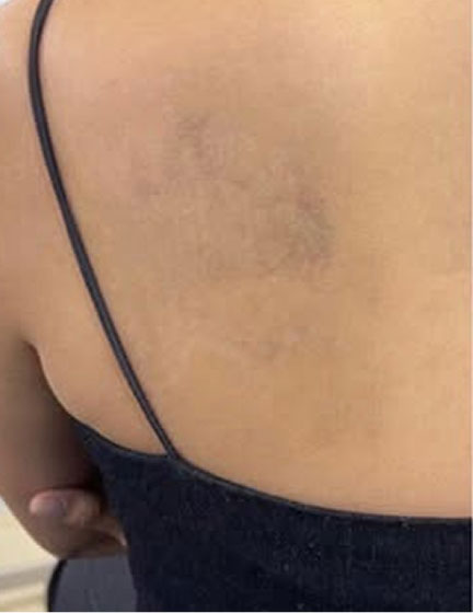 Trước sau cắt cánh mũi 2