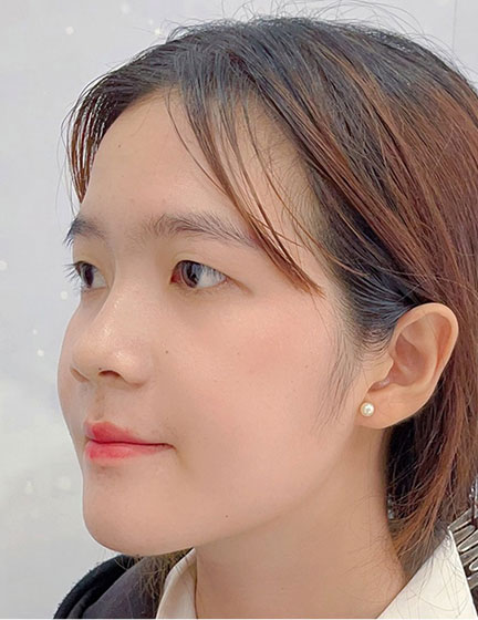 Trước sau cắt cánh mũi 2