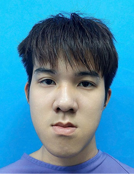 Trước sau cắt cánh mũi 3