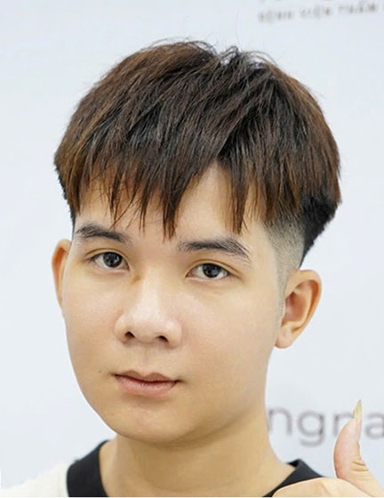 Trước sau cắt cánh mũi 4