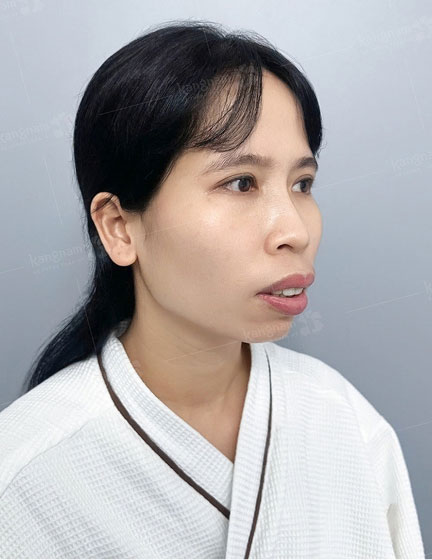 Trước sau cắt cánh mũi 1