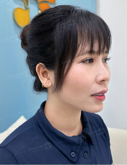 Trước sau cắt cánh mũi 2