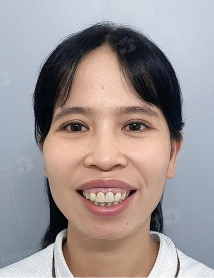 Trước sau cắt cánh mũi 3