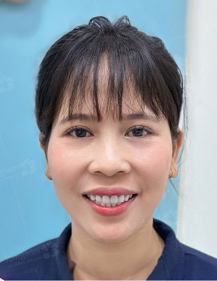 Trước sau cắt cánh mũi 4