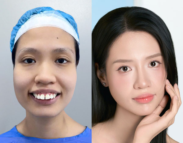 Khách hàng Vũ Thị Tình trước phẫu thuật chỉnh hàm hô tại Kangnam