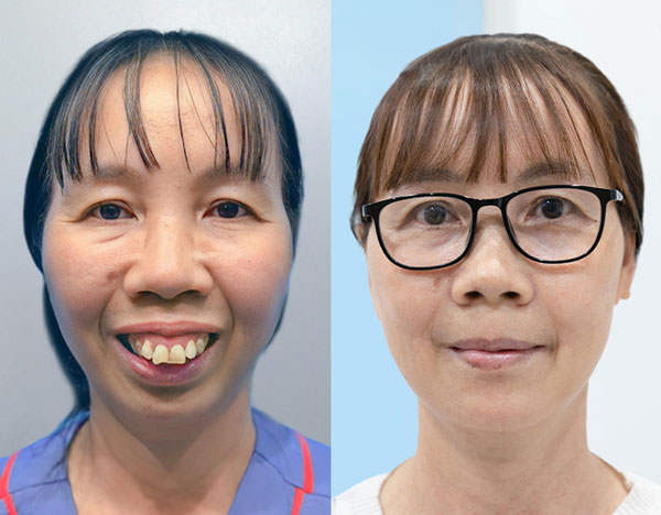 Khách hàng Vũ Thị Thảo trước phẫu thuật chỉnh hàm hô tại Kangnam