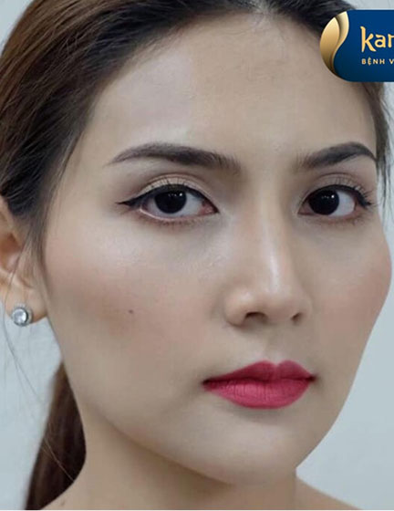 Trước sau cắt cánh mũi 1