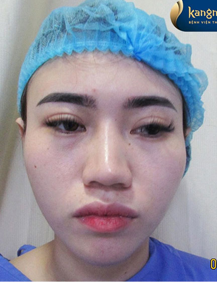 Trước sau cắt cánh mũi 3
