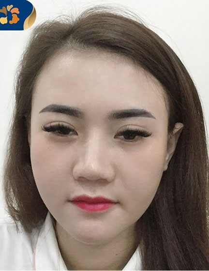 Trước sau cắt cánh mũi 4