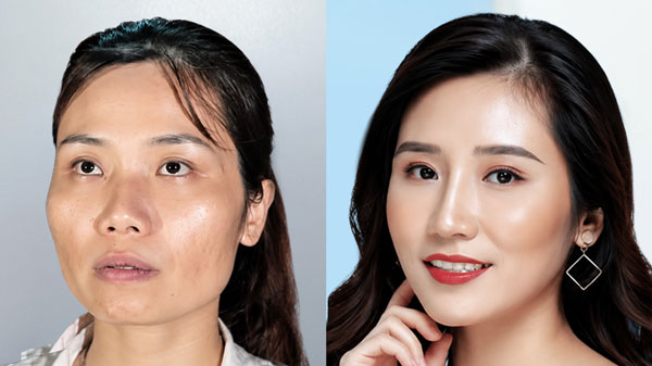 Trước và sau chỉnh hình hàm mặt - hạ gò má của khách hàng Hoàng Oanh tại Kangnam