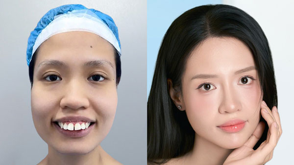 Trước và sau combo chỉnh hàm hô và hạ gò má của khách hàng Vũ Thị Tình tại Kangnam