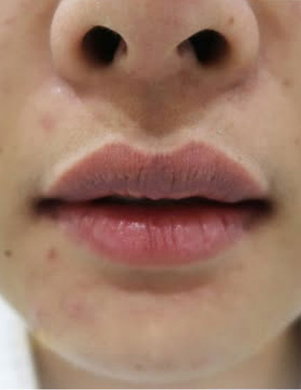 Trước sau cắt cánh mũi 1