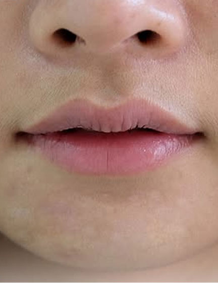 Trước sau cắt cánh mũi 2