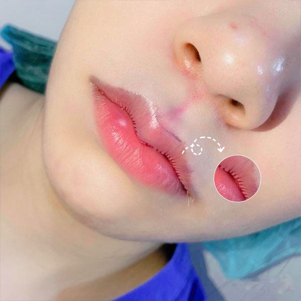 Trước và sau thu mỏng môi khách hàng Lan Thi tại Kangnam