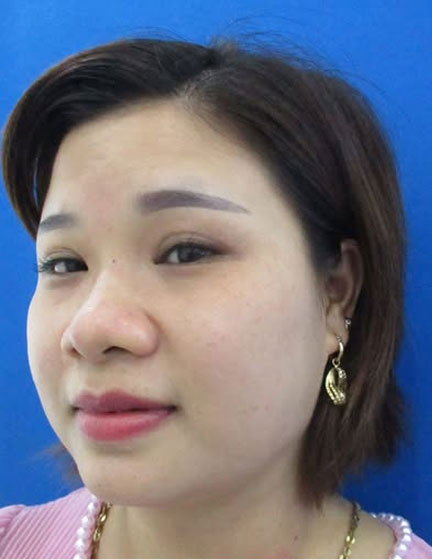 Trước sau cắt cánh mũi 1