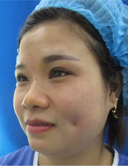 Trước sau cắt cánh mũi 2