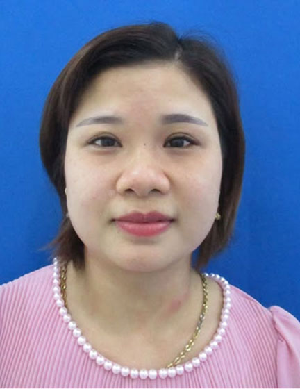 Trước sau cắt cánh mũi 3