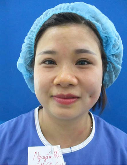 Trước sau cắt cánh mũi 4