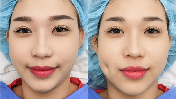 Trước và sau tạo má lúm đồng tiền của khách hàng tại Kangnam