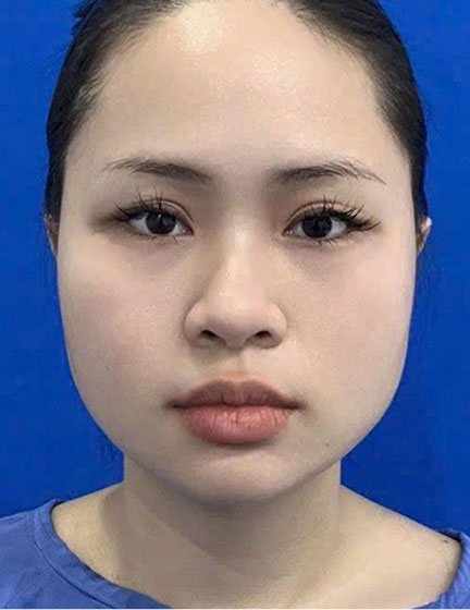 Trước sau cắt cánh mũi 3
