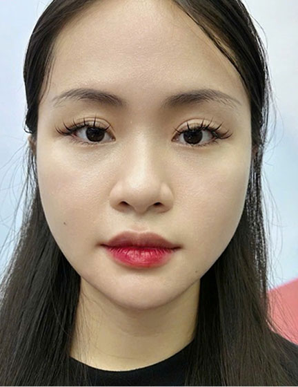 Trước sau cắt cánh mũi 4