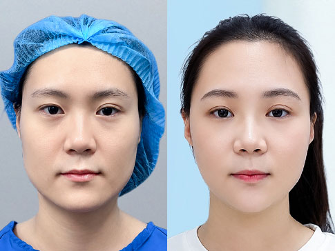 Gọt góc hàm V-line thu gọn hàm vuông bạnh tại Kangnam