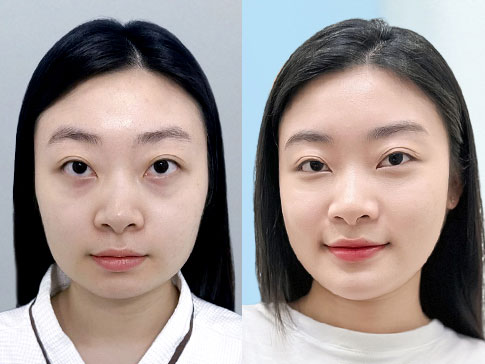 Combo gọt hàm vuông kết hợp trượt cằm tạo dáng V-line tại Kangnam Hà Nội
