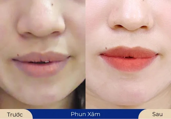 Công nghệ giúp khắc phục tình trạng môi thâm, không đều màu hoàn hảo