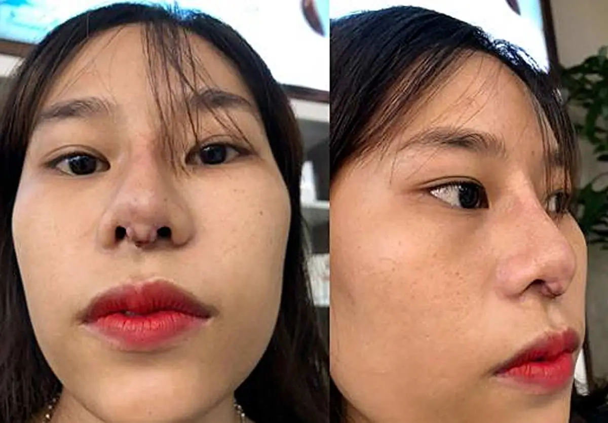 Trước sau cắt cánh mũi 1